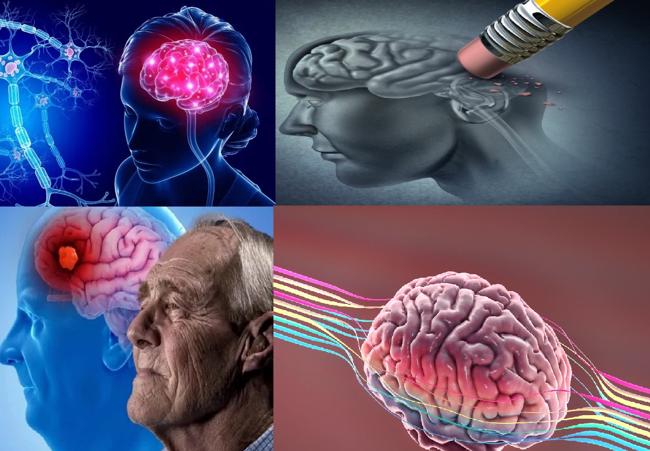 Descubren 5 casos de Alzheimer que se desarrollaron por causa de un tratamiento médico