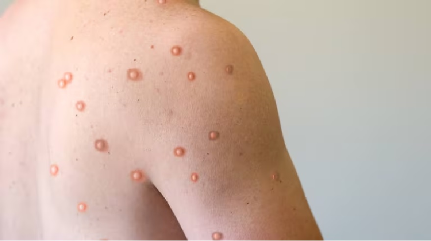 Aislaron a pasajeros que venían a la Argentina por tener síntomas compatibles con viruela del mono