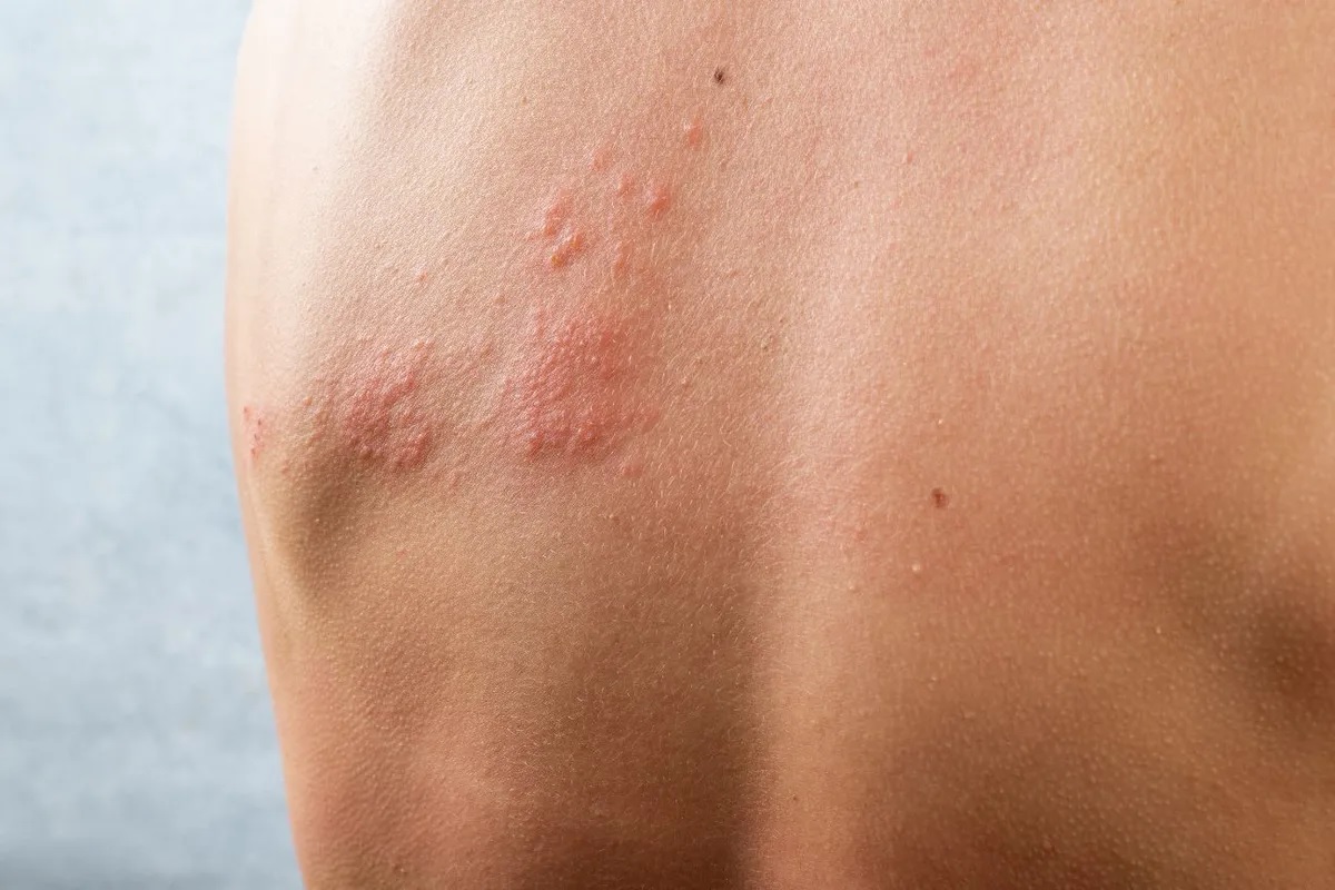 ¿Qué es el herpes zóster?