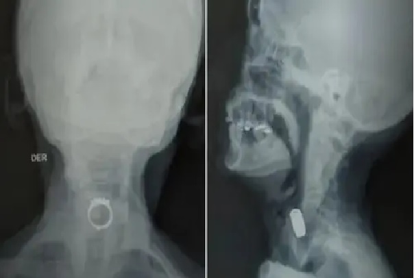 Soñó que era un caramelo: se comió un anillo mientras dormía