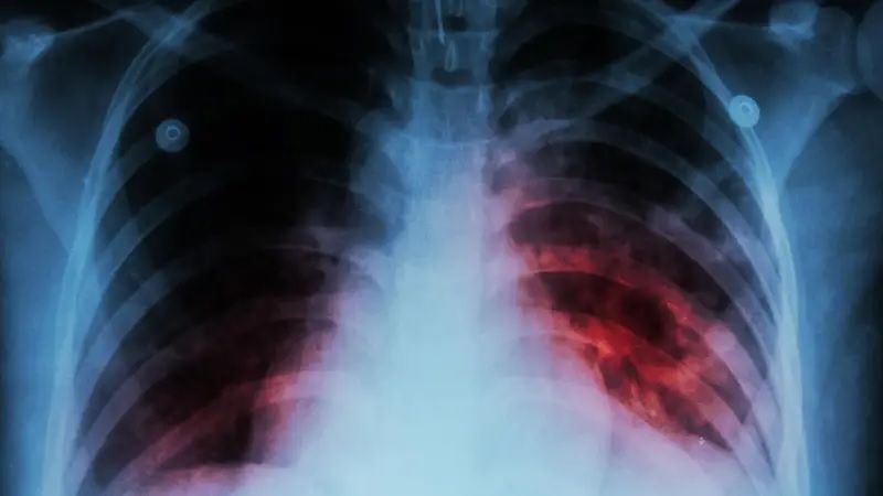 Alerta por r&eacute;cord de tuberculosis en la Argentina