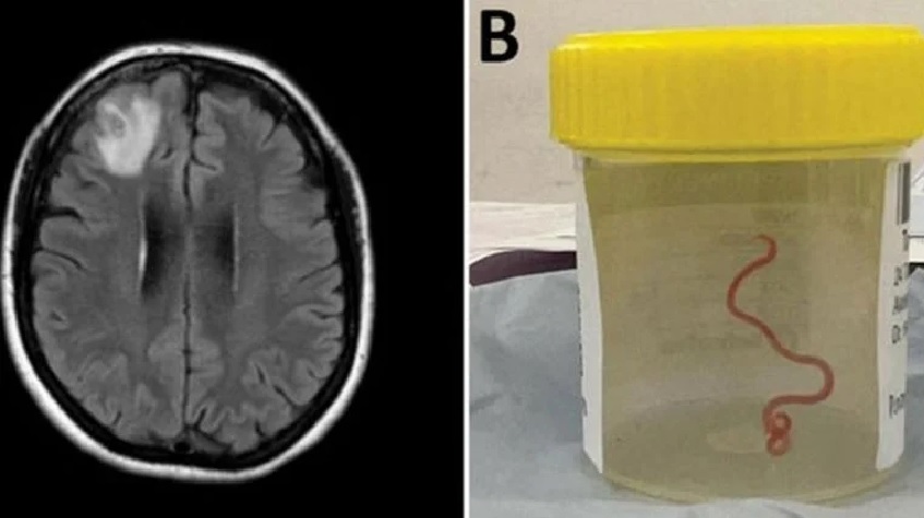 Encuentran por primera vez un gusano vivo en el cerebro de una mujer