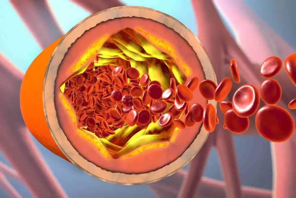 Cuáles son los 3 alimentos que desinflaman arterias y bajan el colesterol