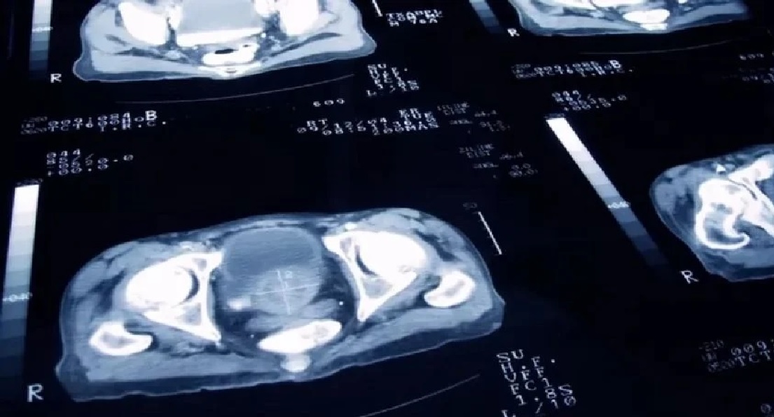 Un estudio trae excelentes noticias sobre la cura del cáncer de próstata