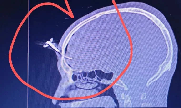 Le clavaron una llave en la cabeza durante una feroz pelea